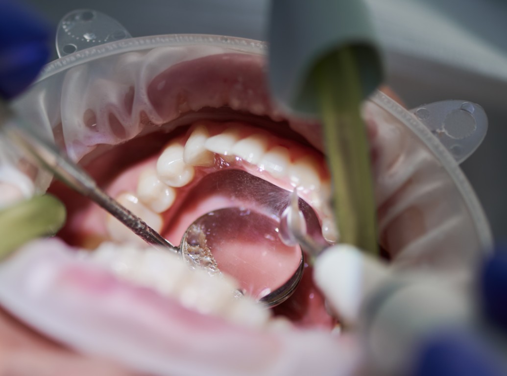 Smile Makeover