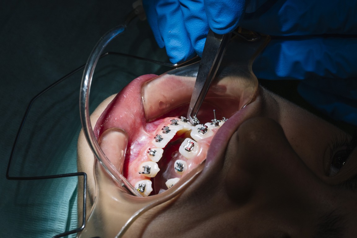 Smile Makeover