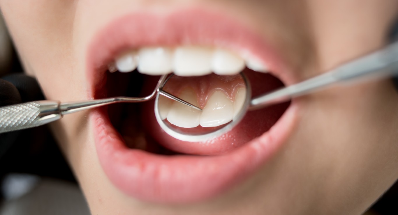 Smile Makeover