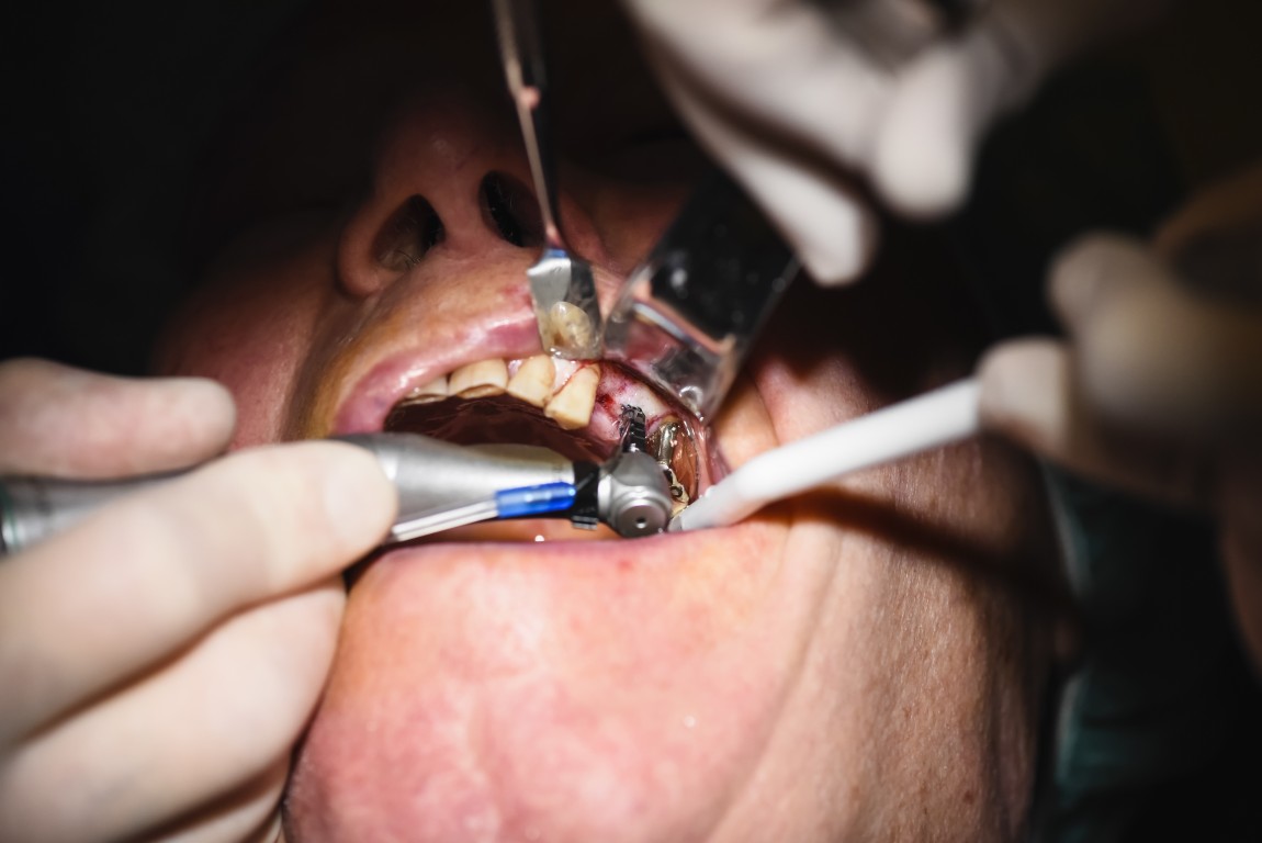 Smile Makeover