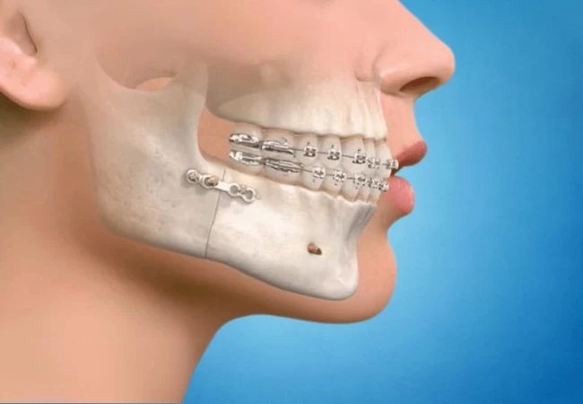 Smile Makeover